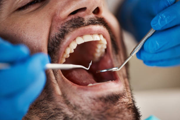 Best Emergency Dentist for Lost Fillings or Crowns in Beloit, KS